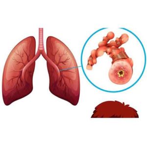 Asthme