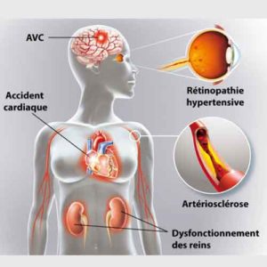Hypertension artérielle